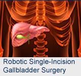 Robotic Single-Incision Gallbladder Surgery